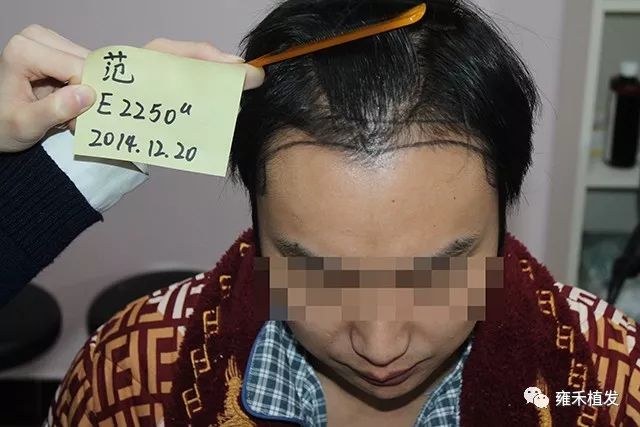 怕上当慎重一个植发医院上海头发种植2290单位