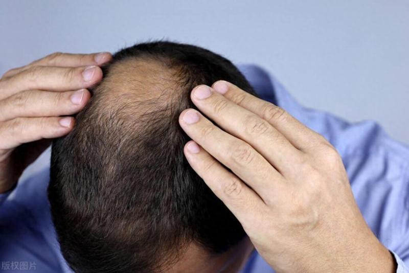 拯救脱发需趁早，分型治疗是关键，脱发的5大证型，你属于哪种？