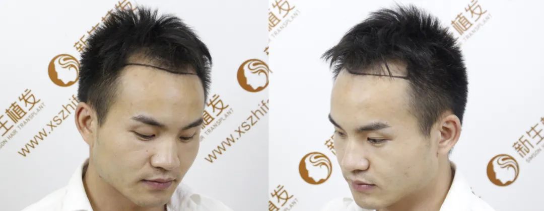 发际线M型脱发严重，植发效果到底有多好？