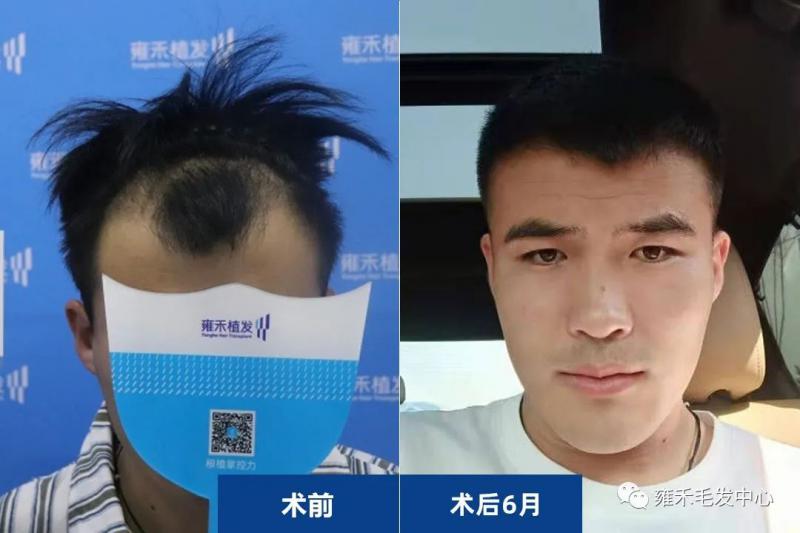 青岛雍禾用FUE为侯先生植发2731单位雍禾植发改变了他。