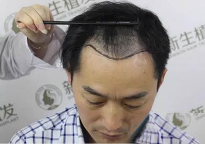 上海新生植发3000毛囊术后效果怎么样？案例分享
