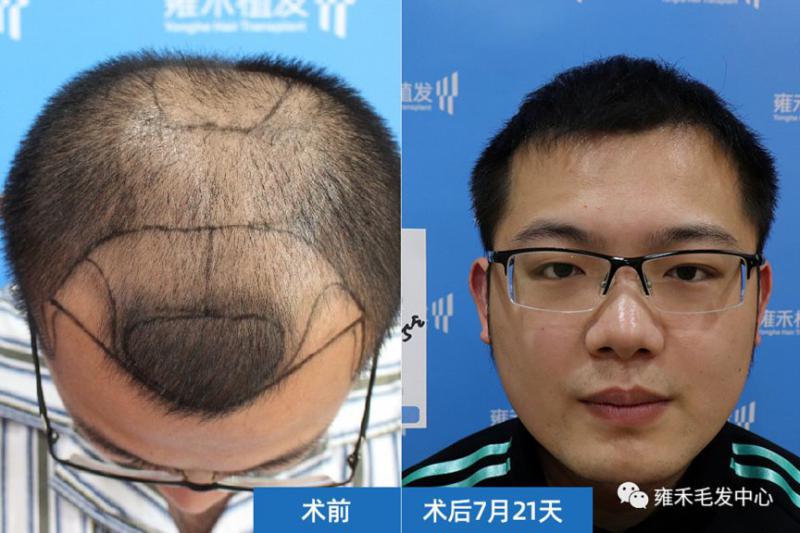张先生在厦门雍禾做植发手术，总计种植3300毛囊单位