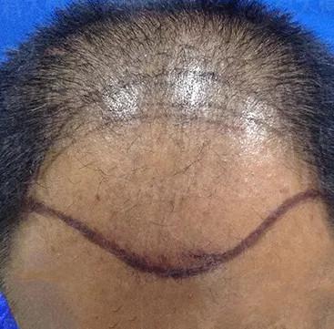 发际线种植 头顶加密种植术后效果分享，终于解决了心头大患