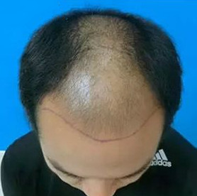 甩掉脂溢性脱发，九个月植发效果案例分享
