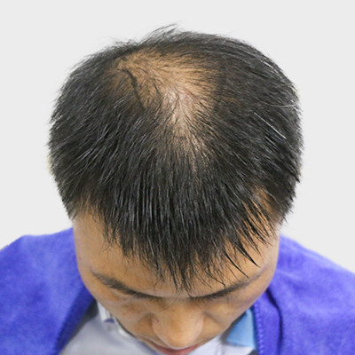 广州倍生植发治疗秃顶术后恢复效果案例