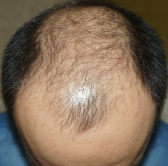 天佑专业植发中心治疗自己的秃顶，真实案例分享