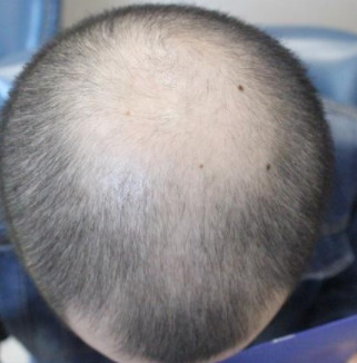 在乌鲁木齐做秃顶种植手术案例分享