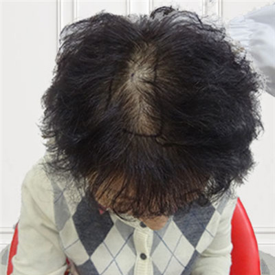 深圳青逸治疗遗传性脱发，术后的恢复状态