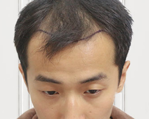 我在天津植发做稀少加密手术后效果心得分享