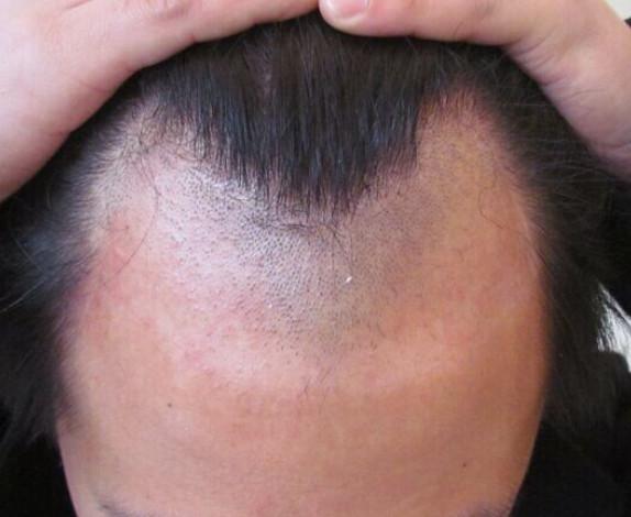 广州碧莲盛植发做得发际线种植手术的真实效果记录