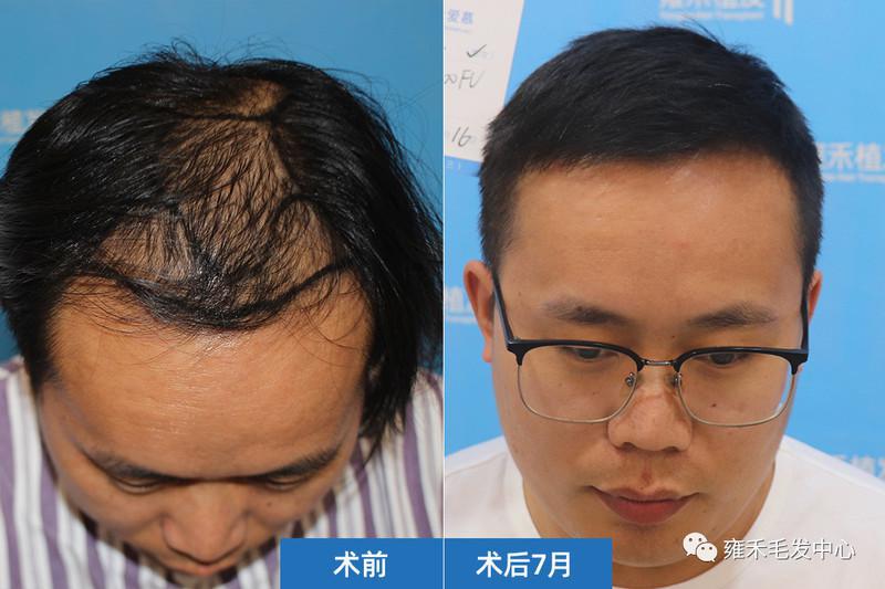 上海雍禾用FUE节约型植发为王先生种植3985单位