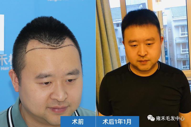 成都雍禾为黎先生植发2100单位原来头发可以种出来的