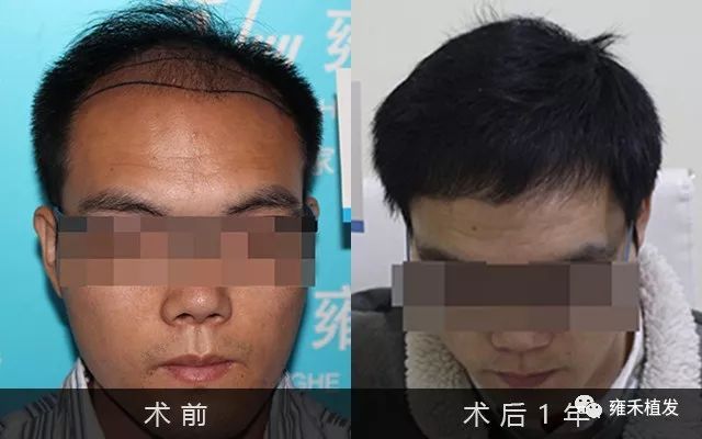 小李在武汉同城一家家地考察植发医院选定武汉雍禾