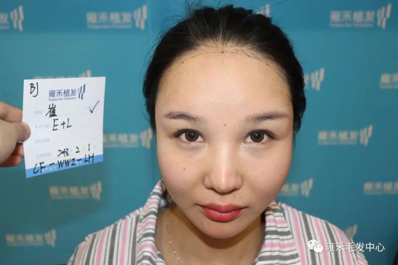 北京雍禾院部的崔医生发际线种植是一个美女咨询师