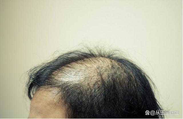 3个原因不重视，脱发会越来越严重，头发稀疏