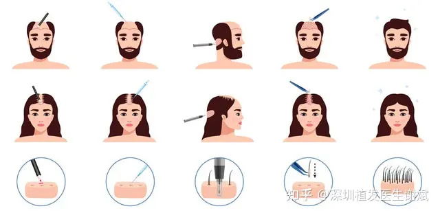 写给深圳准备植发的发友们！你真的了解植发吗？