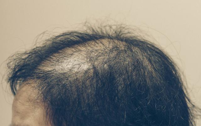 植发可以有效地改善脱发问题？